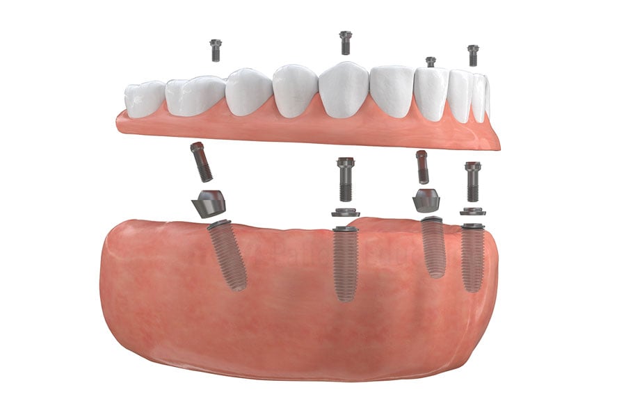 Are you missing all your teeth and would like to get beautiful smile quickly and permanently? Contact us to see if you are a candidate for full mouth restoration with dental implants near Orland Park, IL. Full Mouth Restoration in Orland Park, IL