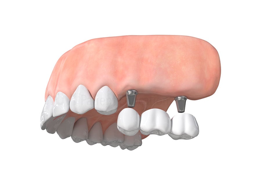 Our expert dental professional team offers dental implant bridge for fixing multiple missing teeth in Orland Park, IL. Dental Implant Bridge in Orland Park IL