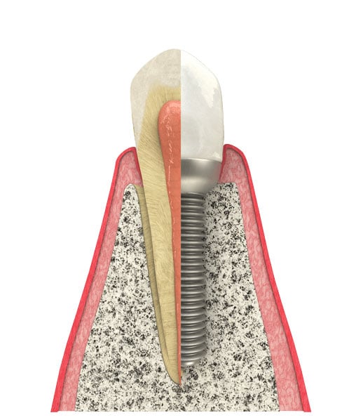 Benefits of Dental Implants in Orland Park, IL