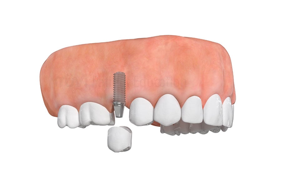 Dental Implants in Orland Park, IL